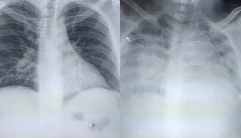 Pluća koja su “nestala” za samo 24 sata: Hirurg objavio snimak, pacijent je umro na respiratoru za dva dana!