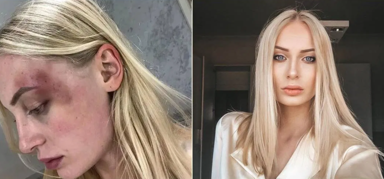 Nakon burne veze manekenka podijelila fotografije modrica koje joj je nanio njen momak