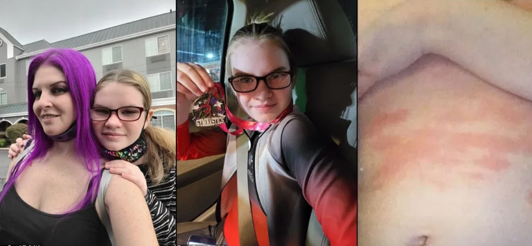 Majka ispričala: ‘Moja kćerka je toliko alergična na vodu da joj svaki put izbiju plikovi i osip, morala je odustati svojih ativnosti’