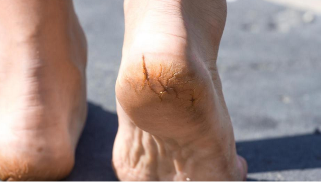 6 mogućih razloga zbog čega vam koža na petama puca i guli se