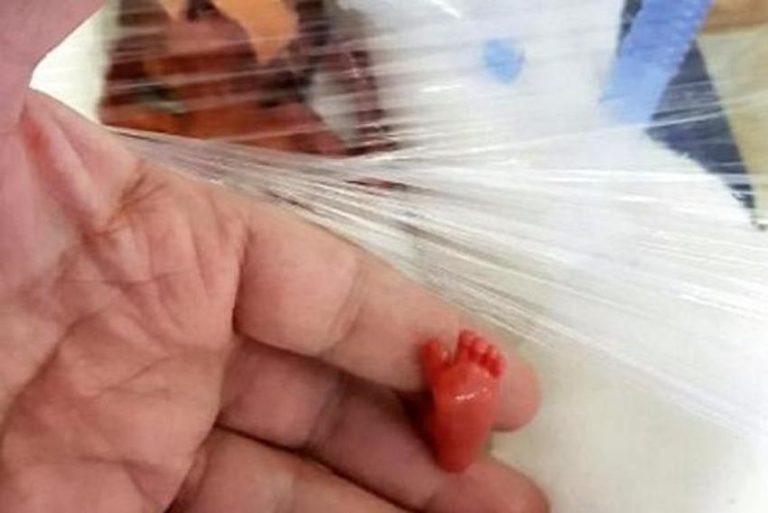 Najmanja beba u Aziji, koja je pri rođenju imala 400 grama, izborila se za život