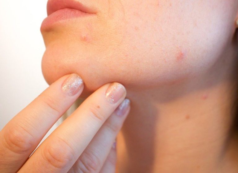 U FBiH nema epidemije šuge ili svraba, ljeti povećana opasnost od mišje groznice