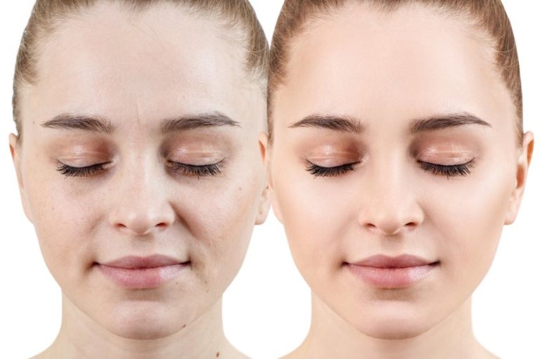 Ispravne prehrambene navike mogu spriječiti pojavu akni