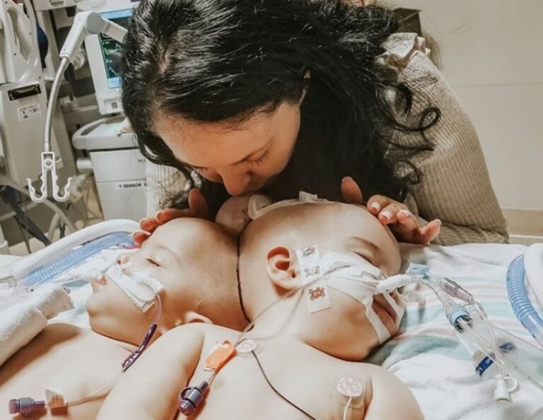 Blizanke rođene spojenih glava uspješno razdvojene nakon 24-satne operacije