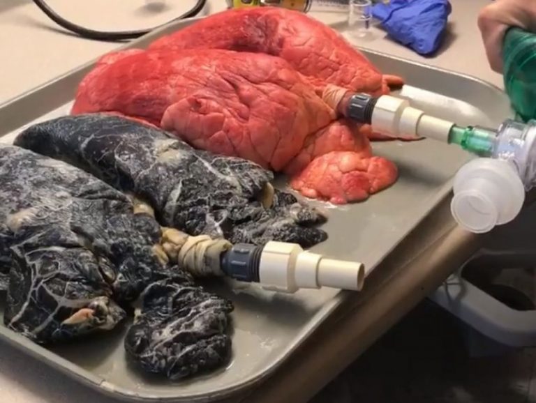 Pogledajte ova pluća: Da li stvarno i dalje želite pušiti?