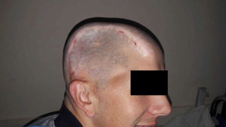 ZENICA: Isprintali dio lobanje i mladiću vratili osmjeh na lice