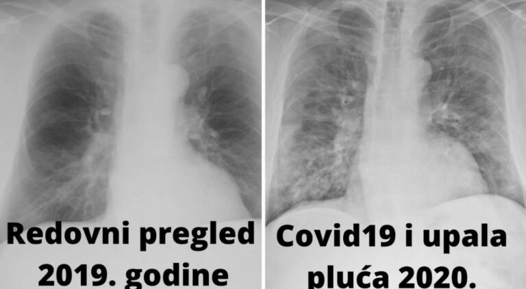 Korona mu uništila pluća: Prošle godine su bila čista, posljedice su trajne