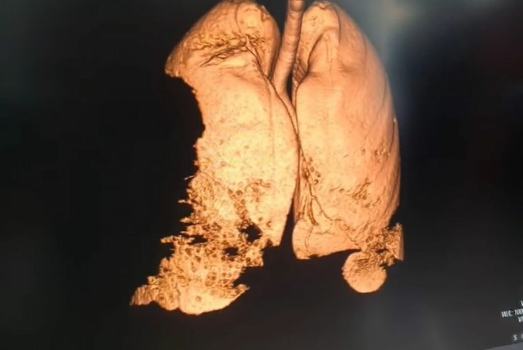 snimak pluca koronavirus prtscr