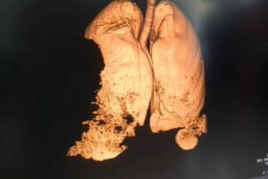 snimak pluca koronavirus prtscr